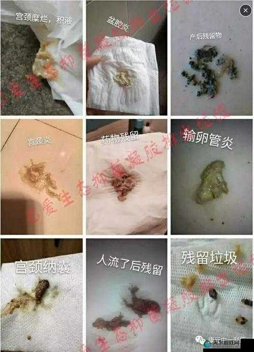 老中医李雪妮排阴蝳：传承千年的中医疗法