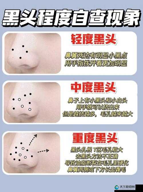 粗大黑头紫大黑头紫挤进:一个奇特现象的深入探讨与分析