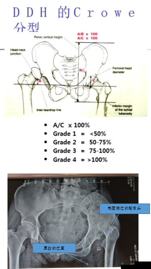 禾然 C1V1 骨科效果如何：对人体健康影响及实际案例分析