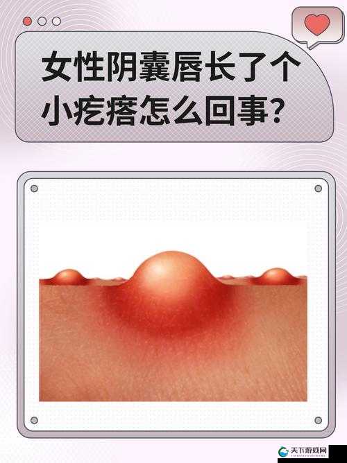 女性大阴囊唇内侧长了水泡，可能是哪些原因引起的？如何正确识别与处理？