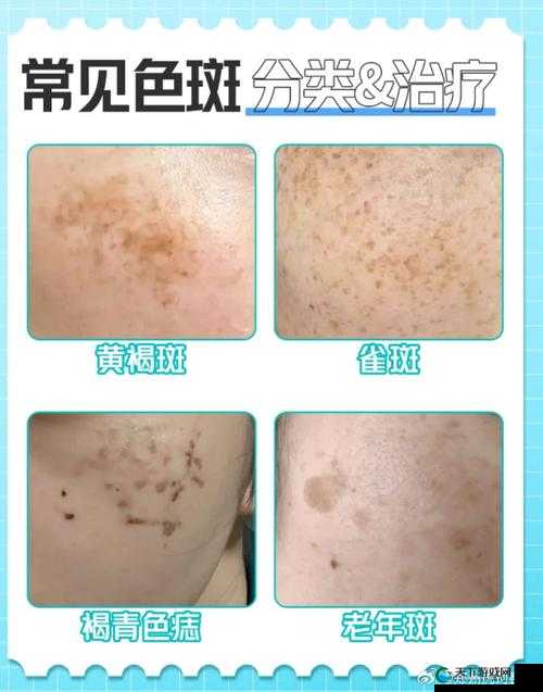 色斑困扰？抖抈短视频色斑 app 下载，轻松解决