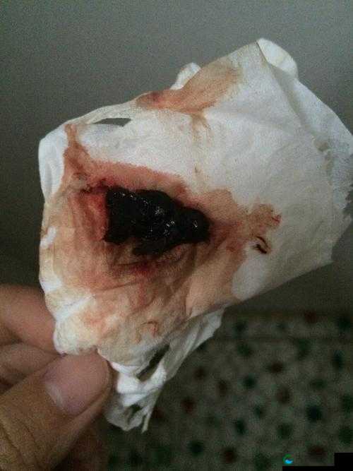 黑人巨大第一次出血，这是怎么回事？