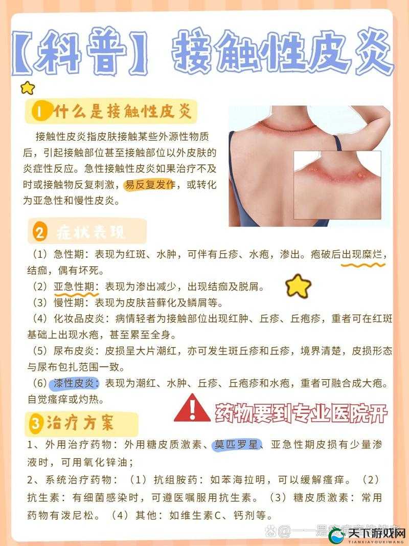 医院计划接触性皮炎有哪些症状？详细症状介绍与应对方法
